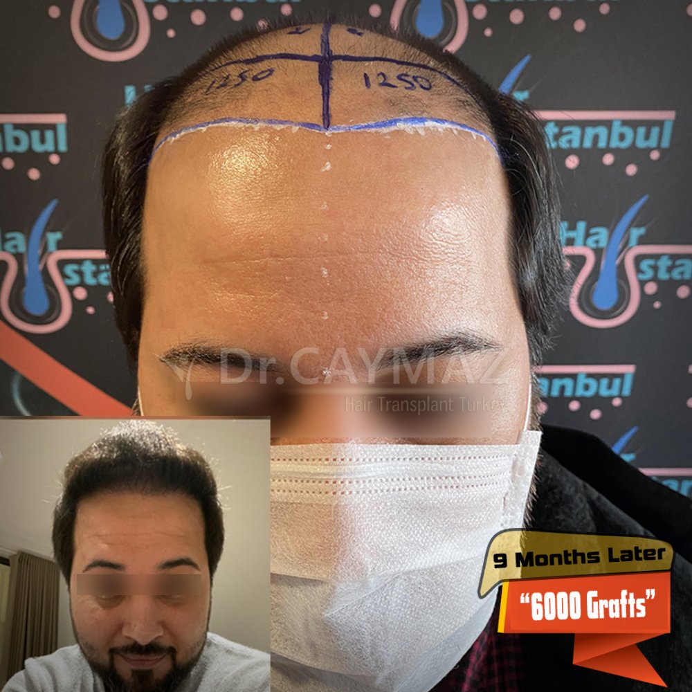 Hair transplant before & after result — frontal, parte superior, corona, 6,000 grafts, Sapphire FUE, 9 months post-op, Norwood 6 — Dr. Erkam Caymaz, Istanbul