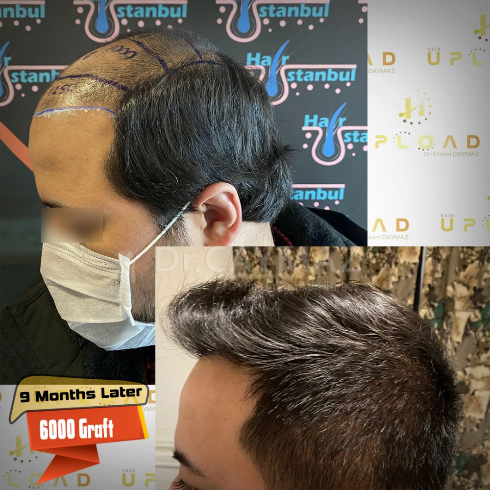 Hair transplant before & after result — frontal, parte superior, corona, 6,000 grafts, Sapphire FUE, 9 months post-op, Norwood 6 — Dr. Erkam Caymaz, Istanbul