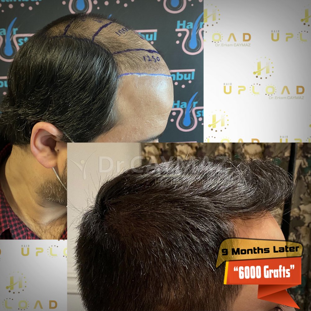 Hair transplant before & after result — frontal, parte superior, corona, 6,000 grafts, Sapphire FUE, 9 months post-op, Norwood 6 — Dr. Erkam Caymaz, Istanbul