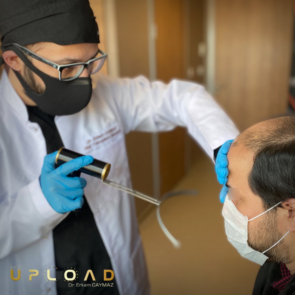 Hair transplant before & after result — frontal, parte superior, corona, 6,000 grafts, Sapphire FUE, 9 months post-op, Norwood 6 — Dr. Erkam Caymaz, Istanbul