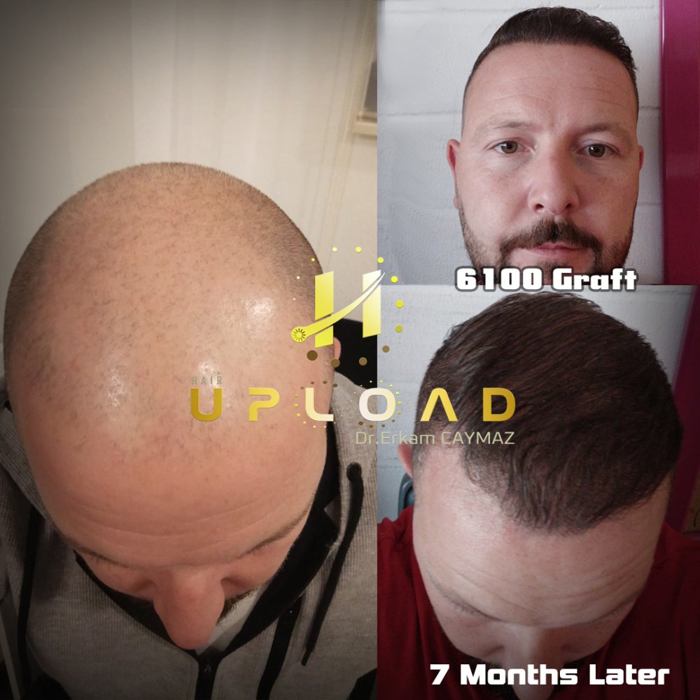Hair transplant before & after result — frontal, parte superior, corona, 6,100 grafts, Sapphire FUE, 12 months post-op, Norwood 6 — Dr. Erkam Caymaz, Istanbul