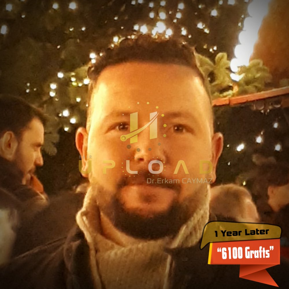 Hair transplant before & after result — frontal, parte superior, corona, 6,100 grafts, Sapphire FUE, 12 months post-op, Norwood 6 — Dr. Erkam Caymaz, Istanbul