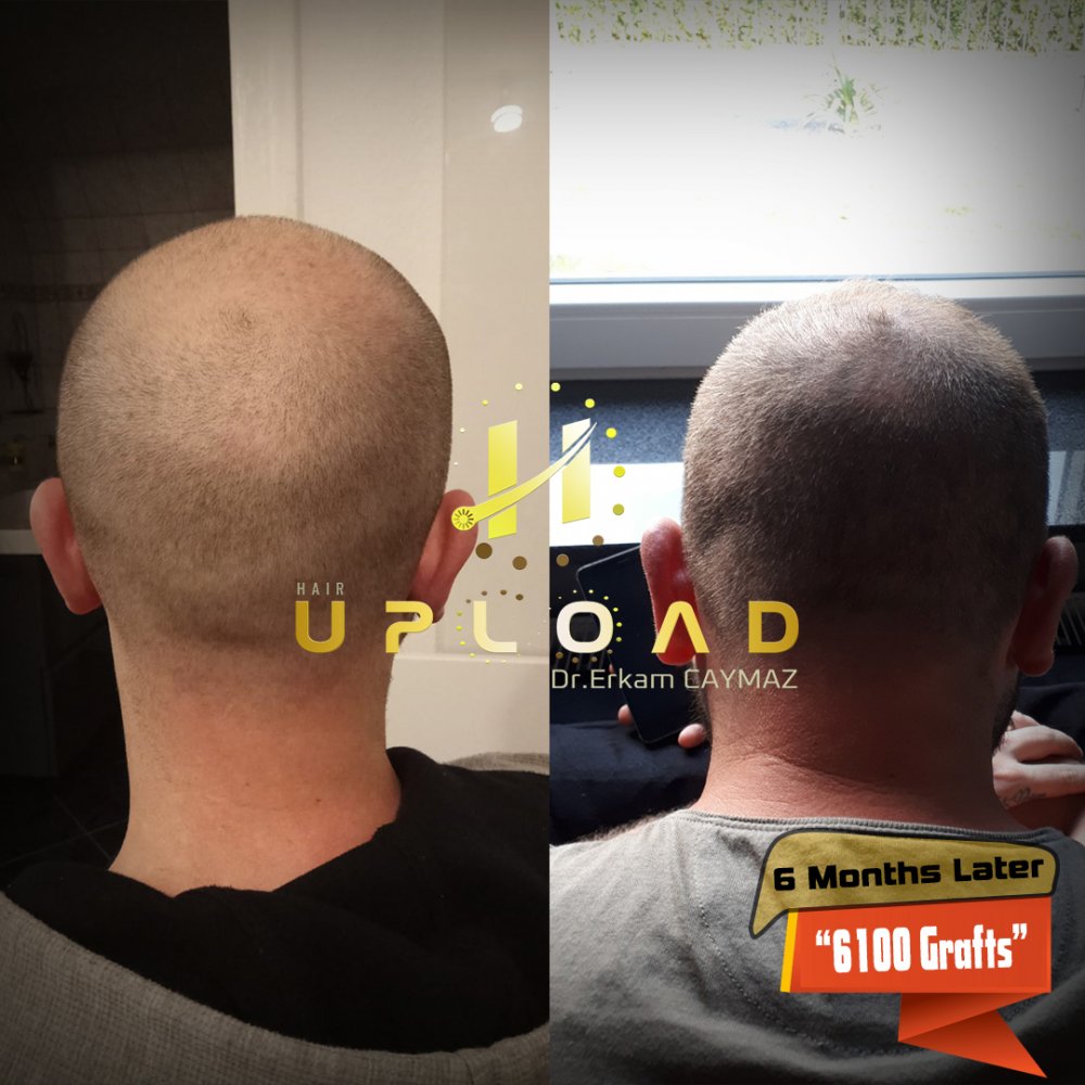 Hair transplant before & after result — frontal, parte superior, corona, 6,100 grafts, Sapphire FUE, 12 months post-op, Norwood 6 — Dr. Erkam Caymaz, Istanbul