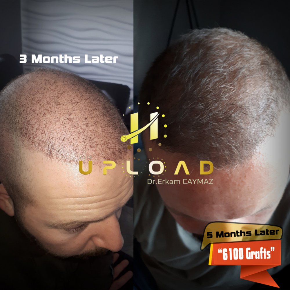 Hair transplant before & after result — frontal, parte superior, corona, 6,100 grafts, Sapphire FUE, 12 months post-op, Norwood 6 — Dr. Erkam Caymaz, Istanbul