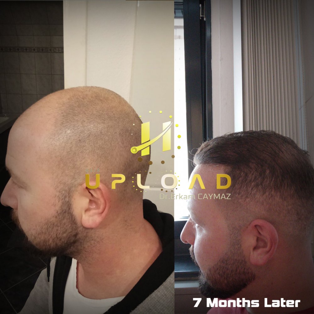 Hair transplant before & after result — frontal, parte superior, corona, 6,100 grafts, Sapphire FUE, 12 months post-op, Norwood 6 — Dr. Erkam Caymaz, Istanbul