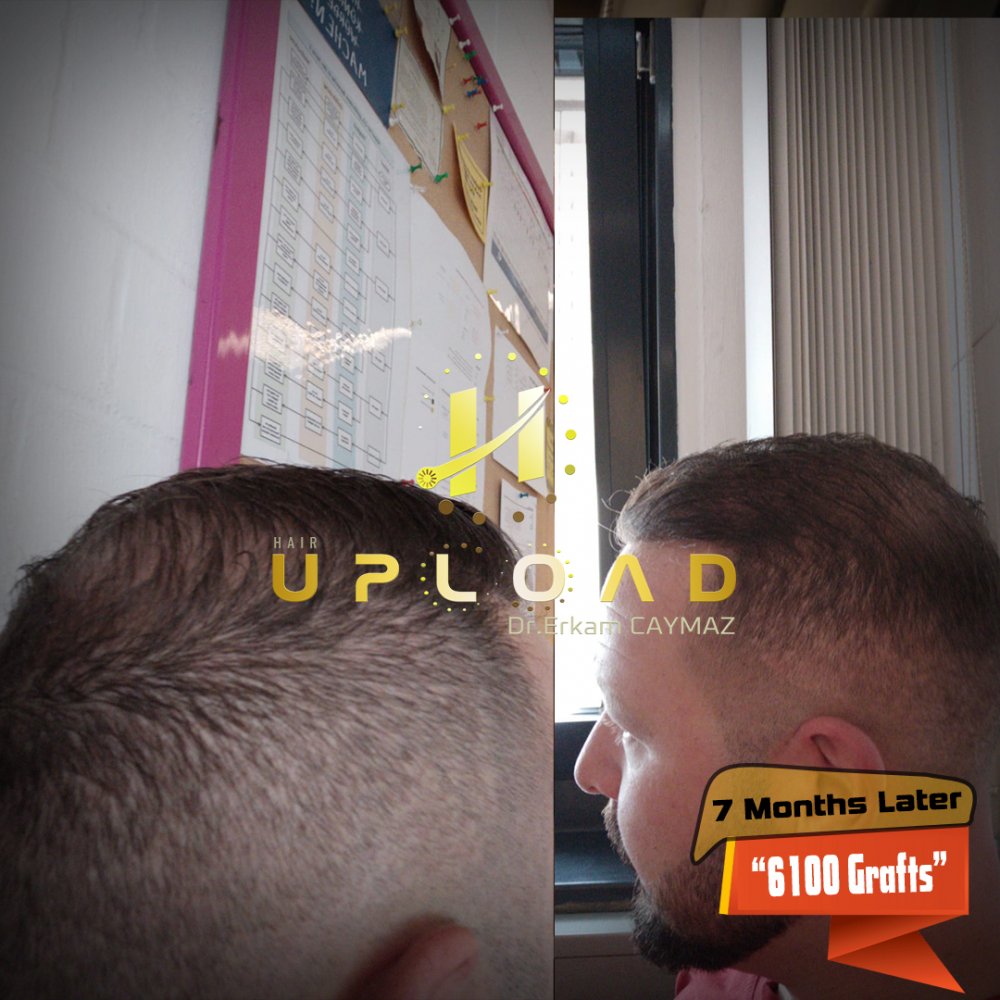 Hair transplant before & after result — frontal, parte superior, corona, 6,100 grafts, Sapphire FUE, 12 months post-op, Norwood 6 — Dr. Erkam Caymaz, Istanbul