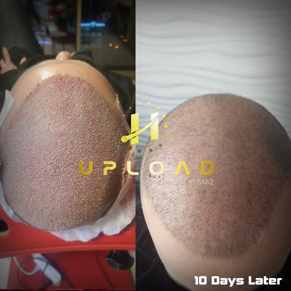 Hair transplant before & after result — frontal, parte superior, corona, 6,100 grafts, Sapphire FUE, 12 months post-op, Norwood 6 — Dr. Erkam Caymaz, Istanbul
