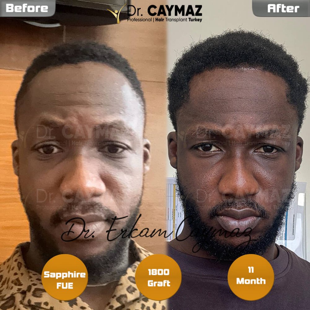 Afro Amazing Result - 1800 Graft - 11 Month — hair transplant before & after — frontal, 1,800 grafts, Sapphire FUE, 12 months post-op, Norwood 2 — Dr. Erkam Caymaz, Istanbul