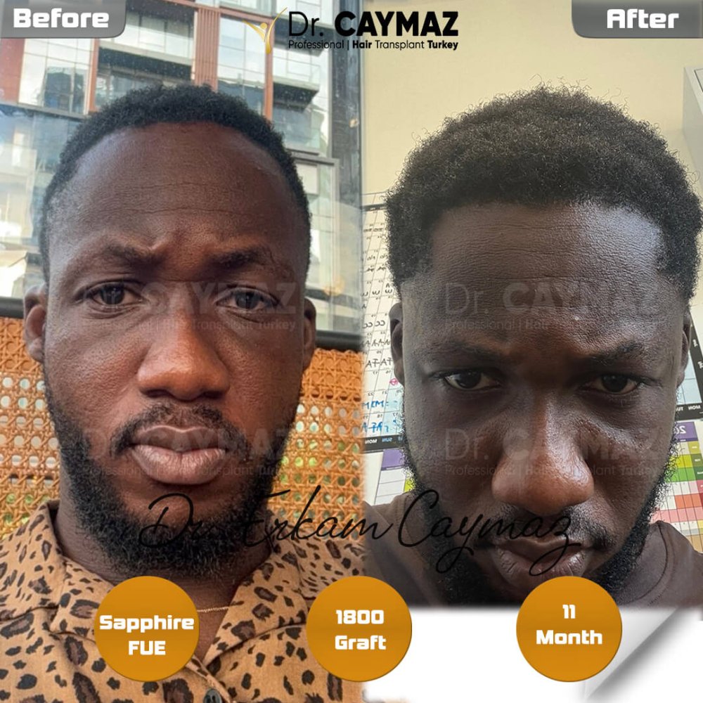 Afro Amazing Result - 1800 Graft - 11 Month — hair transplant before & after — frontal, 1,800 grafts, Sapphire FUE, 12 months post-op, Norwood 2 — Dr. Erkam Caymaz, Istanbul
