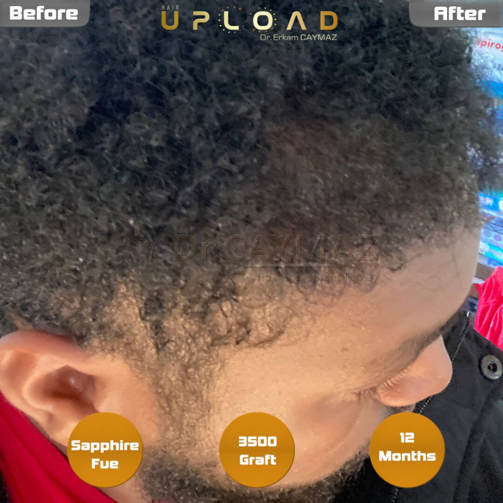 Afro-American Hair and Beard Result - 12 Months - Sapphire - 3500 Graft — hair transplant before & after — frontal, beard, 3,500 grafts, Sapphire FUE, 12 months post-op, Norwood 2 — Dr. Erkam Caymaz, Istanbul