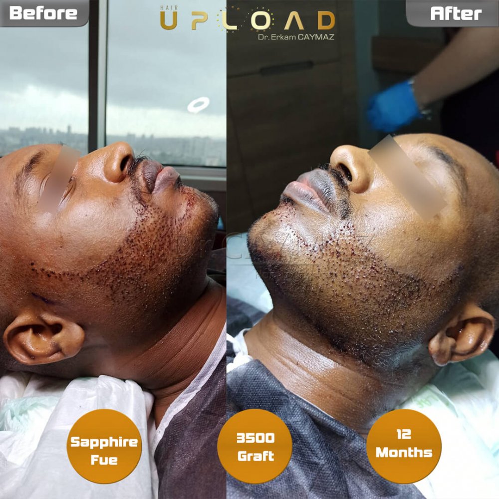 Afro-American Hair and Beard Result - 12 Months - Sapphire - 3500 Graft — hair transplant before & after — frontal, beard, 3,500 grafts, Sapphire FUE, 12 months post-op, Norwood 2 — Dr. Erkam Caymaz, Istanbul