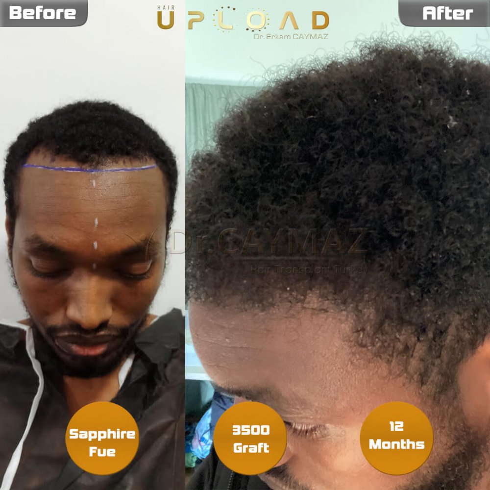 Afro-American Hair and Beard Result - 12 Months - Sapphire - 3500 Graft — hair transplant before & after — frontal, beard, 3,500 grafts, Sapphire FUE, 12 months post-op, Norwood 2 — Dr. Erkam Caymaz, Istanbul
