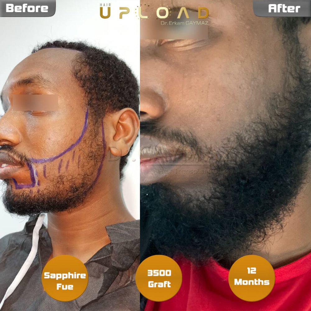 Afro-American Hair and Beard Result - 12 Months - Sapphire - 3500 Graft — hair transplant before & after — frontal, beard, 3,500 grafts, Sapphire FUE, 12 months post-op, Norwood 2 — Dr. Erkam Caymaz, Istanbul