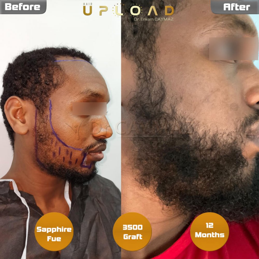 Afro-American Hair and Beard Result - 12 Months - Sapphire - 3500 Graft — hair transplant before & after — frontal, beard, 3,500 grafts, Sapphire FUE, 12 months post-op, Norwood 2 — Dr. Erkam Caymaz, Istanbul
