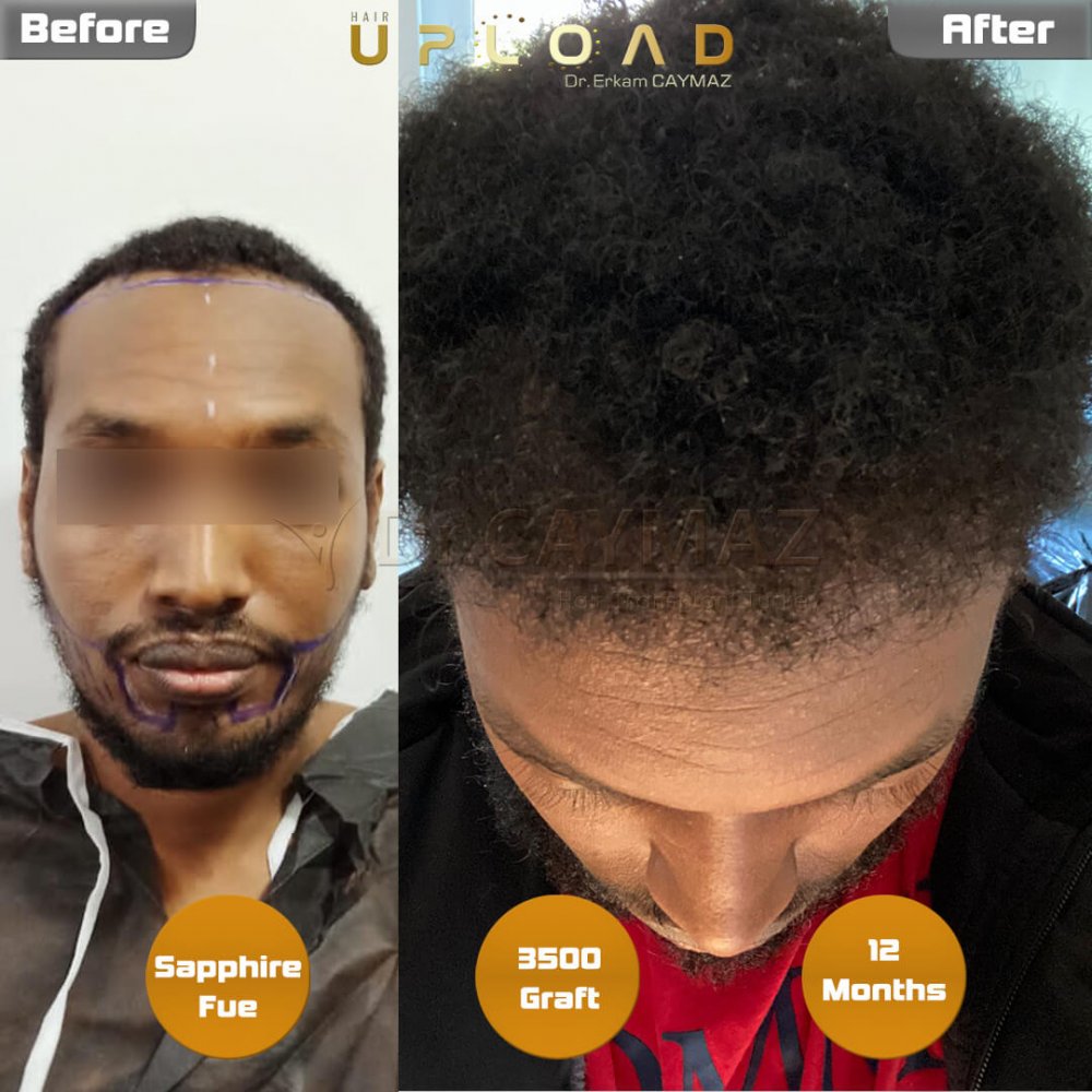 Afro-American Hair and Beard Result - 12 Months - Sapphire - 3500 Graft — hair transplant before & after — frontal, beard, 3,500 grafts, Sapphire FUE, 12 months post-op, Norwood 2 — Dr. Erkam Caymaz, Istanbul