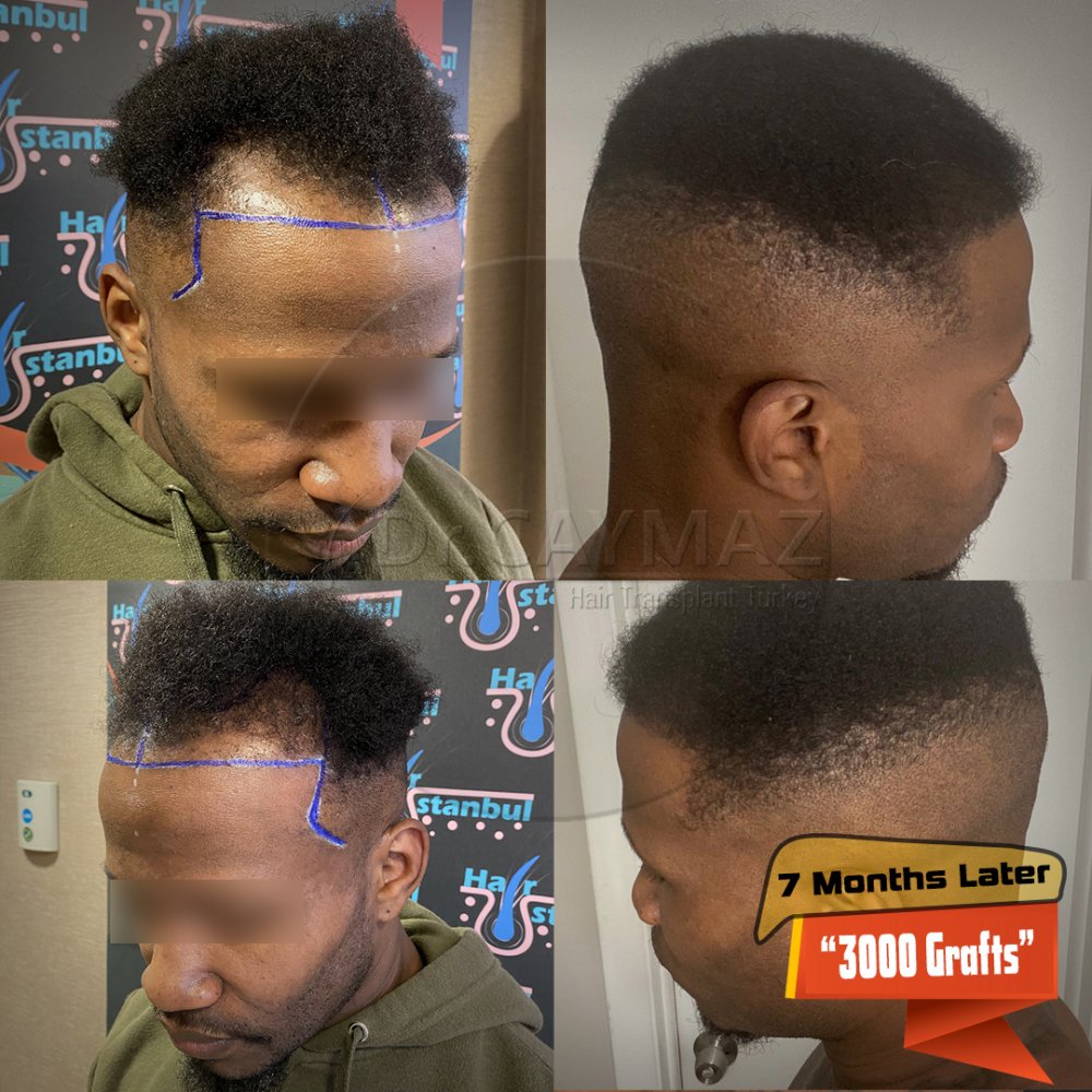AFROAMERICAN - 3000 GRAFT - 10 MONTHS PROCESS - WITH SAPPHIRE FUE — hair transplant before & after — frontal, 3,000 grafts, Sapphire FUE, 10 months post-op, Norwood 3 — Dr. Erkam Caymaz, Istanbul