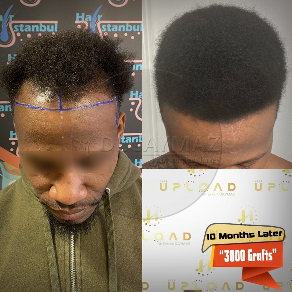 AFROAMERICAN - 3000 GRAFT - 10 MONTHS PROCESS - WITH SAPPHIRE FUE — hair transplant before & after — frontal, 3,000 grafts, Sapphire FUE, 10 months post-op, Norwood 3 — Dr. Erkam Caymaz, Istanbul