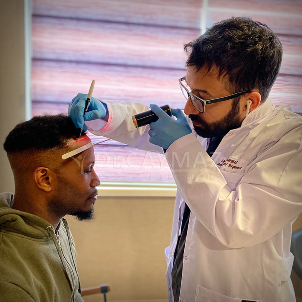 AFROAMERICAN - 3000 GRAFT - 10 MONTHS PROCESS - WITH SAPPHIRE FUE — hair transplant before & after — frontal, 3,000 grafts, Sapphire FUE, 10 months post-op, Norwood 3 — Dr. Erkam Caymaz, Istanbul