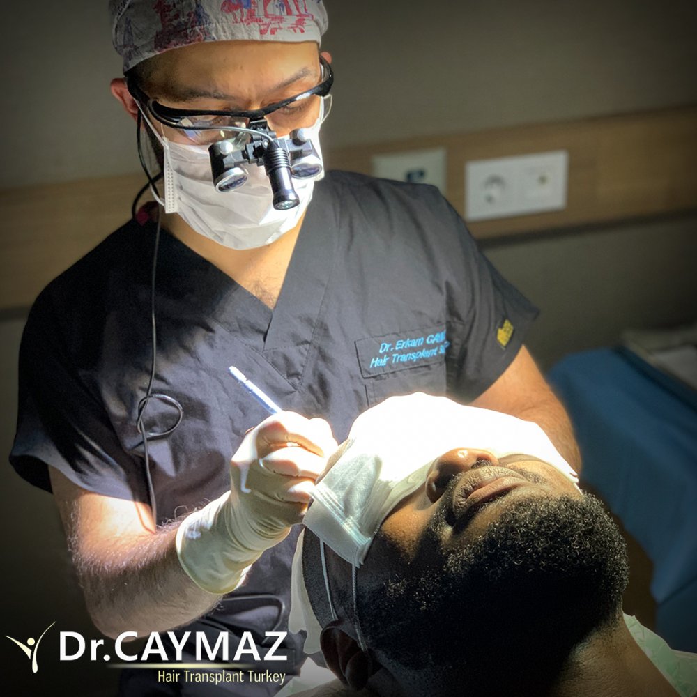 Afroamerican - 3500 Graft - 6 Months Result - Sapphire Fue — hair transplant before & after — frontal, top of head, 3,500 grafts, Sapphire FUE, 6 months post-op, Norwood 3 — Dr. Erkam Caymaz, Istanbul