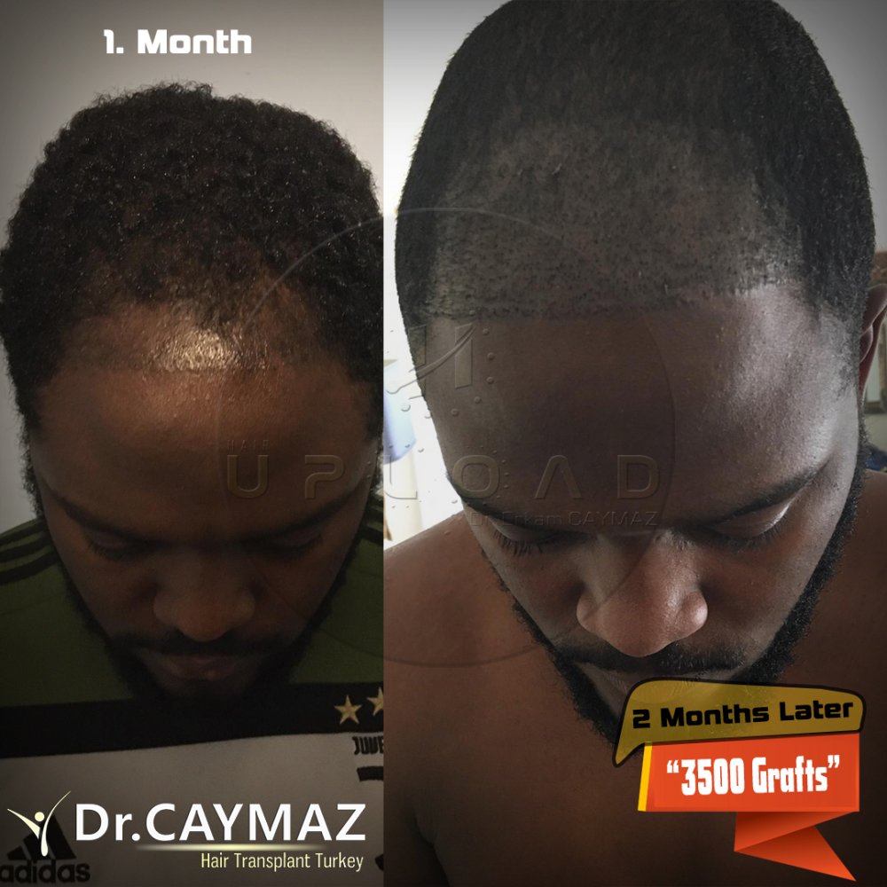 Afroamerican - 3500 Graft - 6 Months Result - Sapphire Fue — hair transplant before & after — frontal, top of head, 3,500 grafts, Sapphire FUE, 6 months post-op, Norwood 3 — Dr. Erkam Caymaz, Istanbul