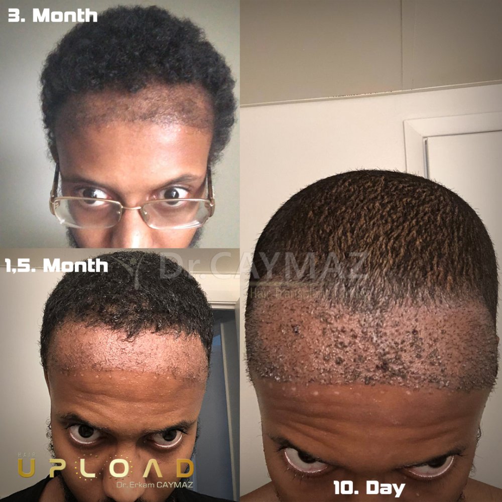 Afroamerican - 3600 Graft - 5,5 Months Result - Sapphire Fue — hair transplant before & after — frontal, sienes, 3,600 grafts, Sapphire FUE, 6 months post-op, Norwood 3 — Dr. Erkam Caymaz, Istanbul