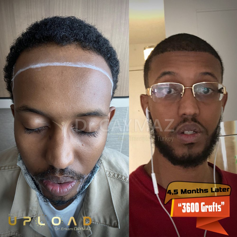 Afroamerican - 3600 Graft - 5,5 Months Result - Sapphire Fue — hair transplant before & after — frontal, sienes, 3,600 grafts, Sapphire FUE, 6 months post-op, Norwood 3 — Dr. Erkam Caymaz, Istanbul