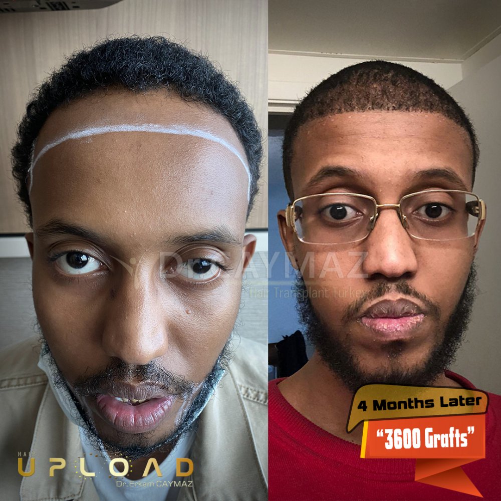 Afroamerican - 3600 Graft - 5,5 Months Result - Sapphire Fue — hair transplant before & after — frontal, sienes, 3,600 grafts, Sapphire FUE, 6 months post-op, Norwood 3 — Dr. Erkam Caymaz, Istanbul