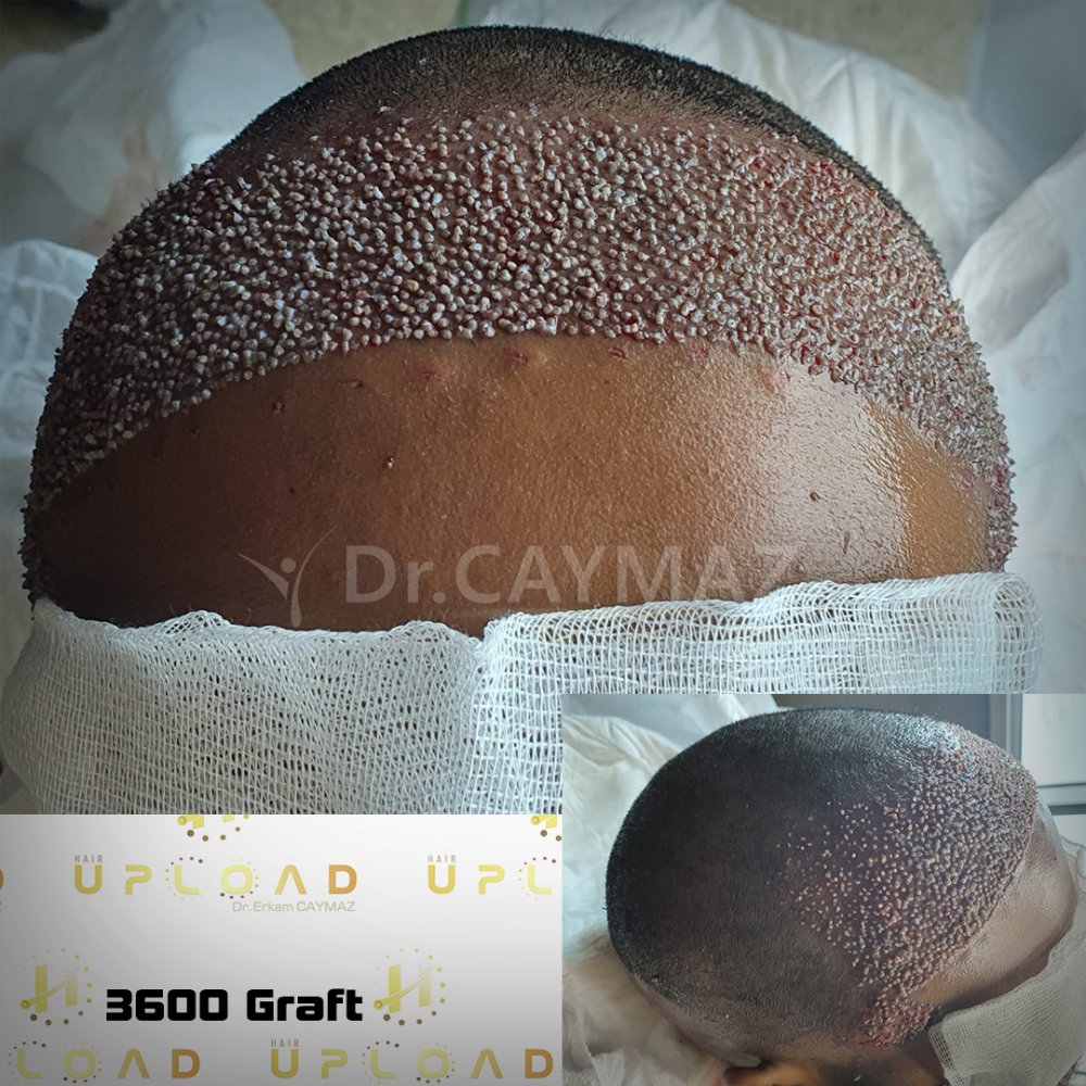 Afroamerican - 3600 Graft - 5,5 Months Result - Sapphire Fue — hair transplant before & after — frontal, sienes, 3,600 grafts, Sapphire FUE, 6 months post-op, Norwood 3 — Dr. Erkam Caymaz, Istanbul