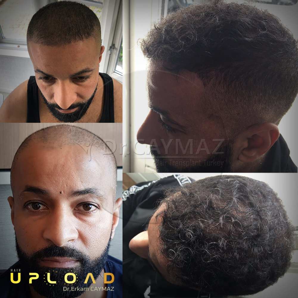 Hair transplant before & after result — Dr. Erkam Caymaz, Istanbul