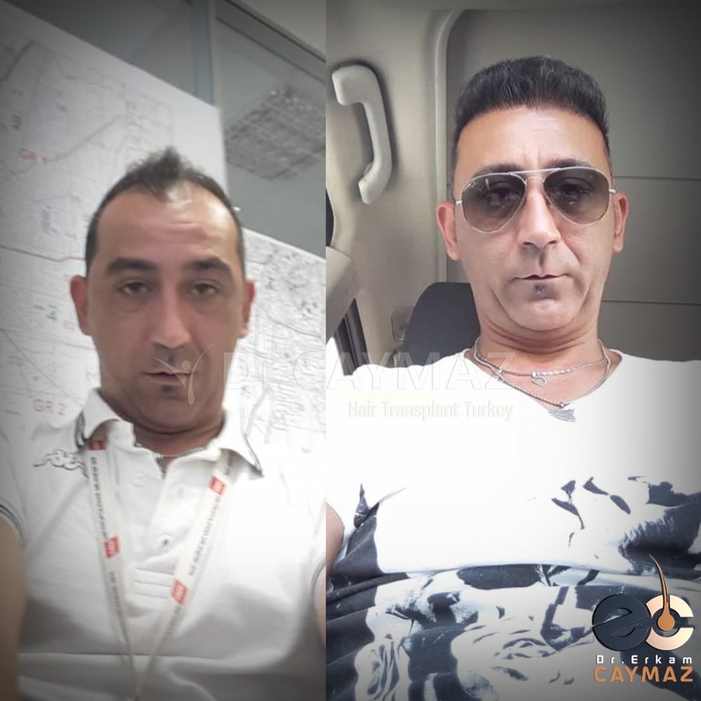 Hair transplant before & after result — Dr. Erkam Caymaz, Istanbul
