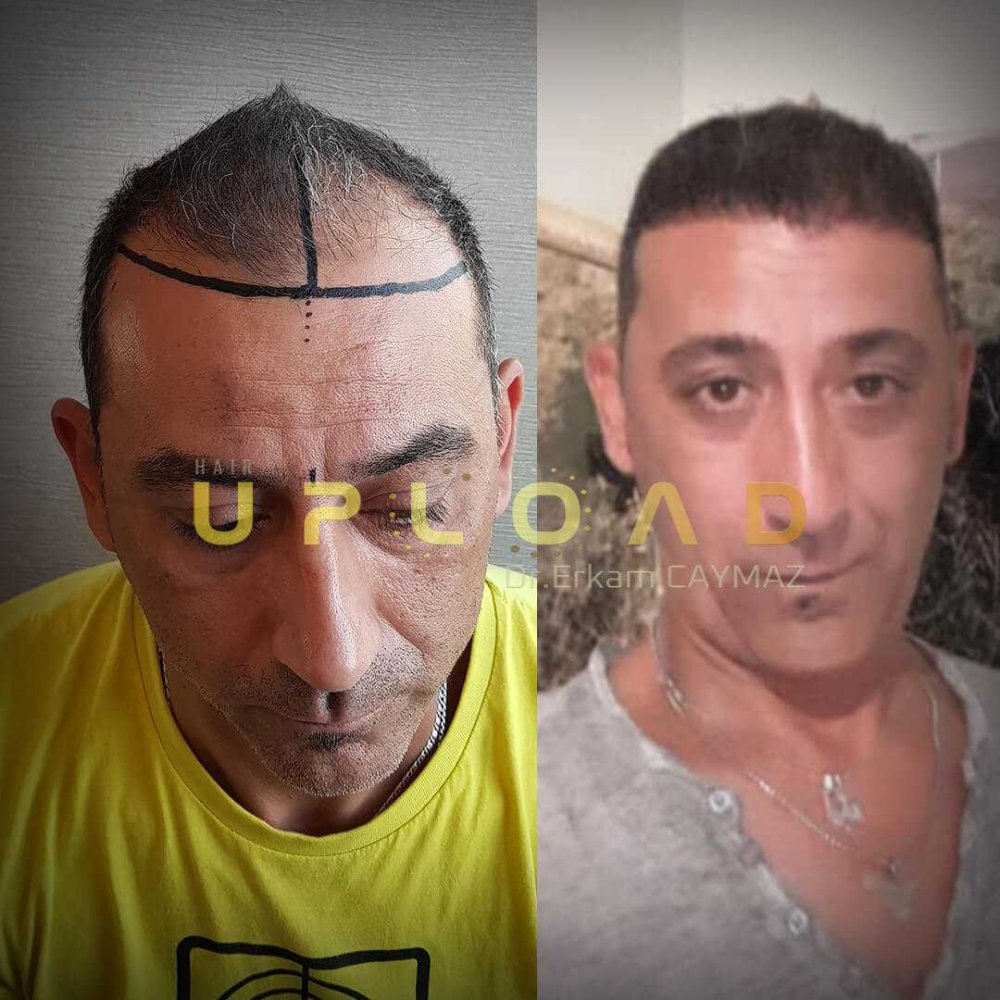 Hair transplant before & after result — Dr. Erkam Caymaz, Istanbul