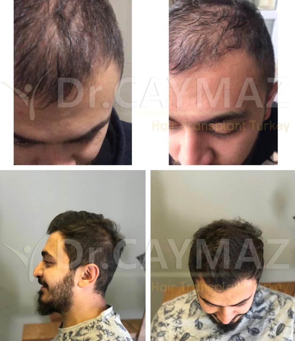 Hair transplant before & after result — Dr. Erkam Caymaz, Istanbul