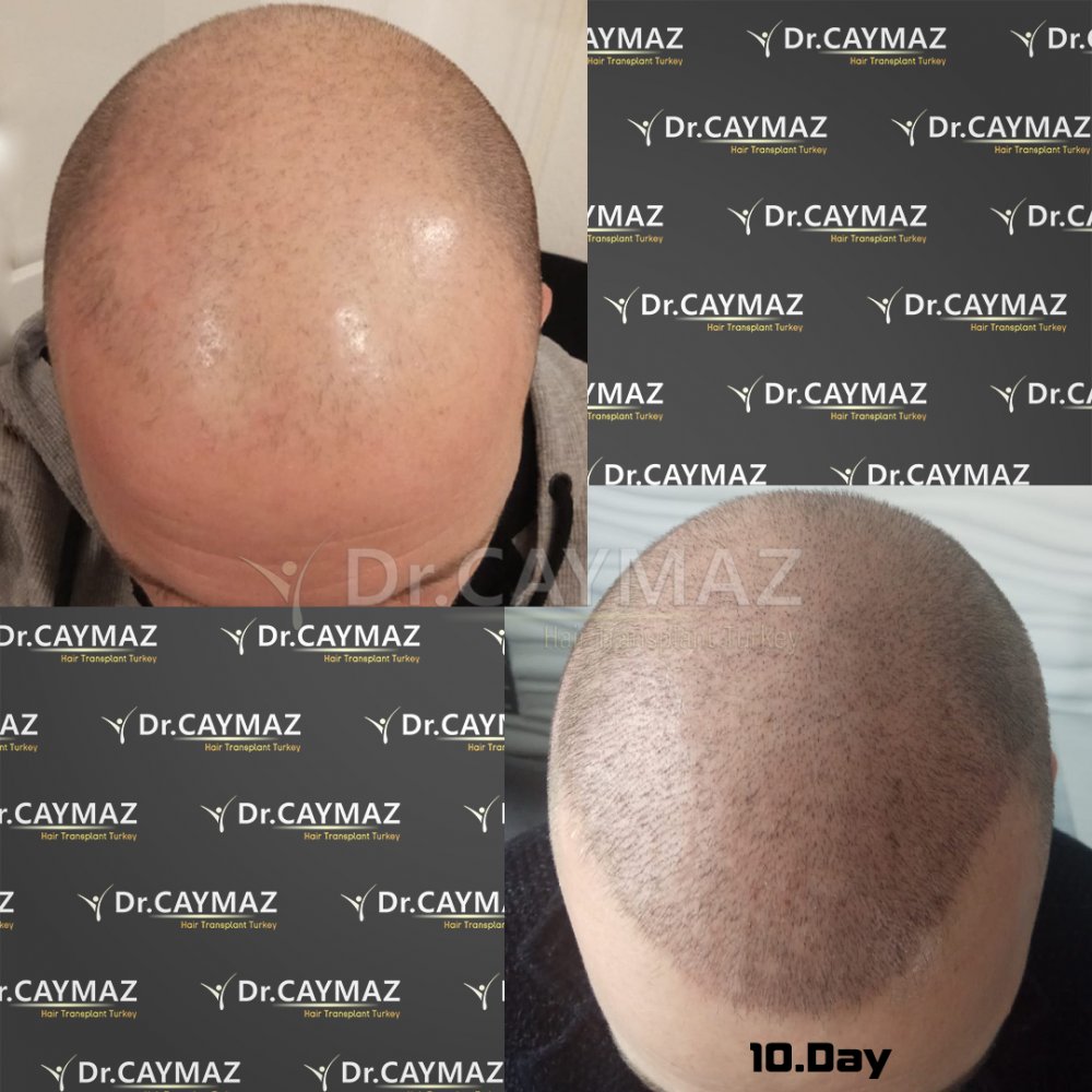 Hair transplant before & after result — Dr. Erkam Caymaz, Istanbul