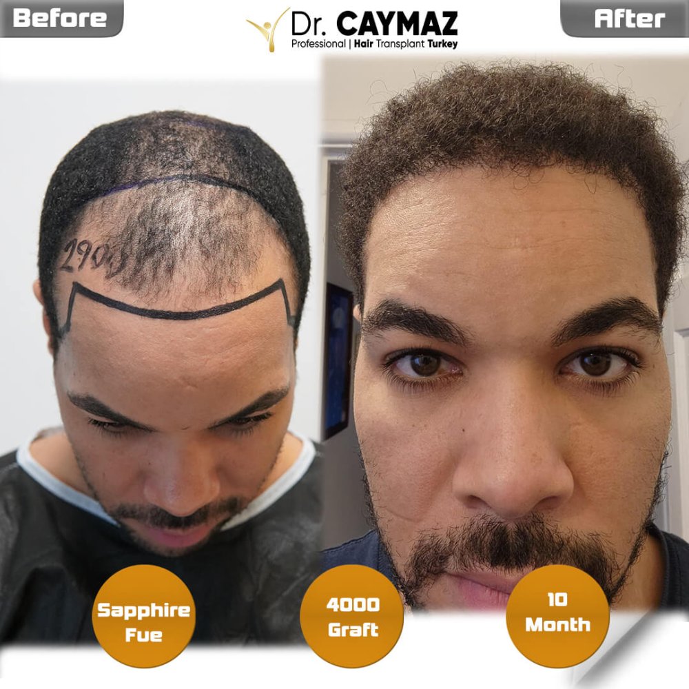 Hair transplant before & after result — frontal, kopfoberseite, 4,000 grafts, Sapphire FUE, 10 months post-op, Norwood 4 — Dr. Erkam Caymaz, Istanbul