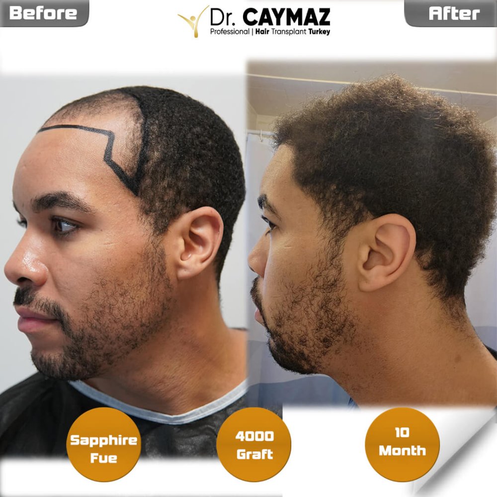 Hair transplant before & after result — frontal, kopfoberseite, 4,000 grafts, Sapphire FUE, 10 months post-op, Norwood 4 — Dr. Erkam Caymaz, Istanbul
