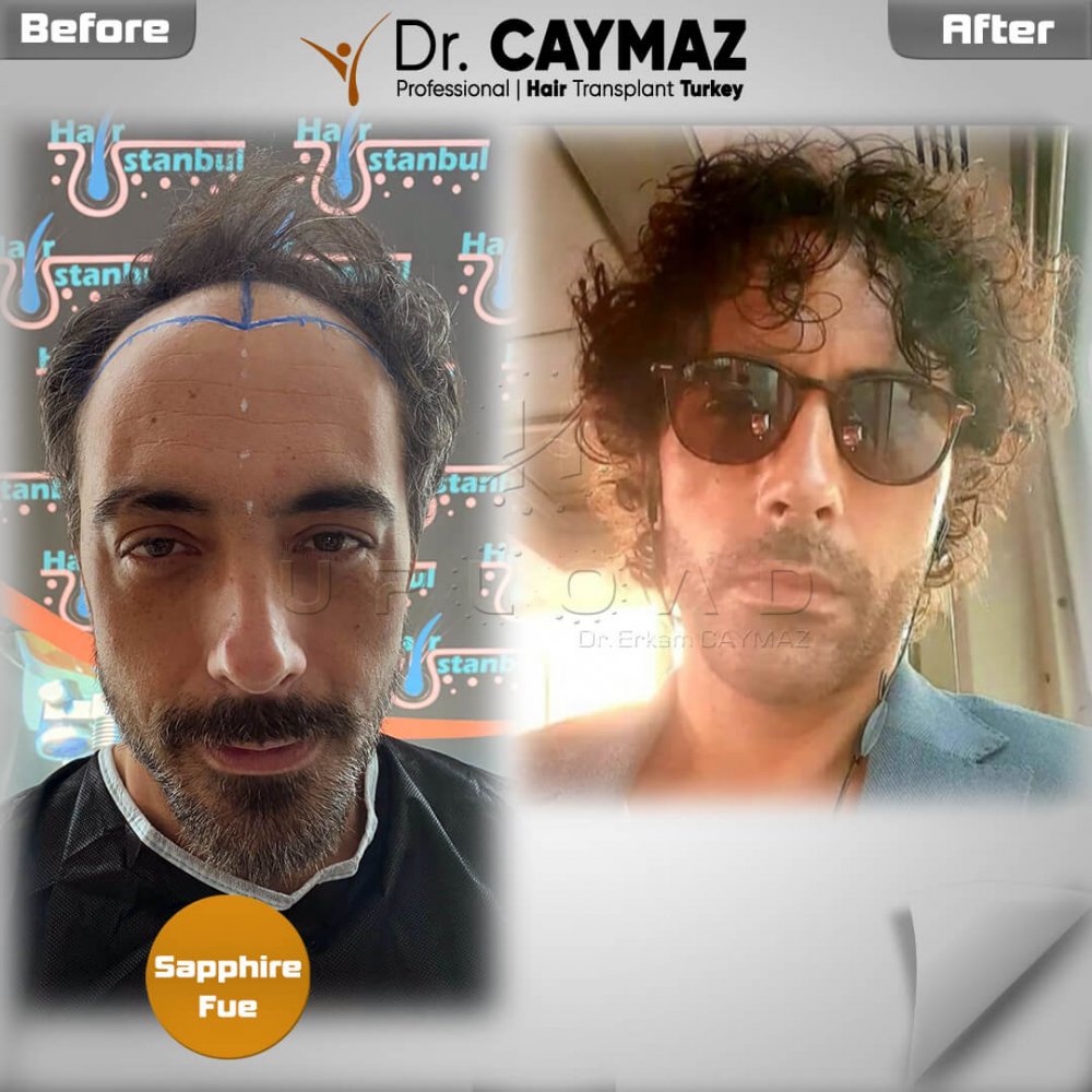 Hair transplant before & after result — Sapphire FUE — Dr. Erkam Caymaz, Istanbul