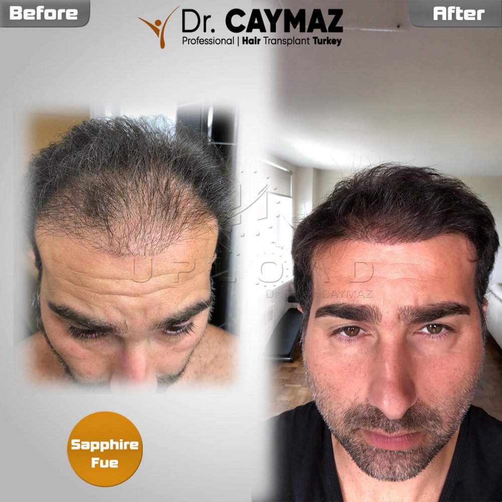 Hair transplant before & after result — Sapphire FUE — Dr. Erkam Caymaz, Istanbul