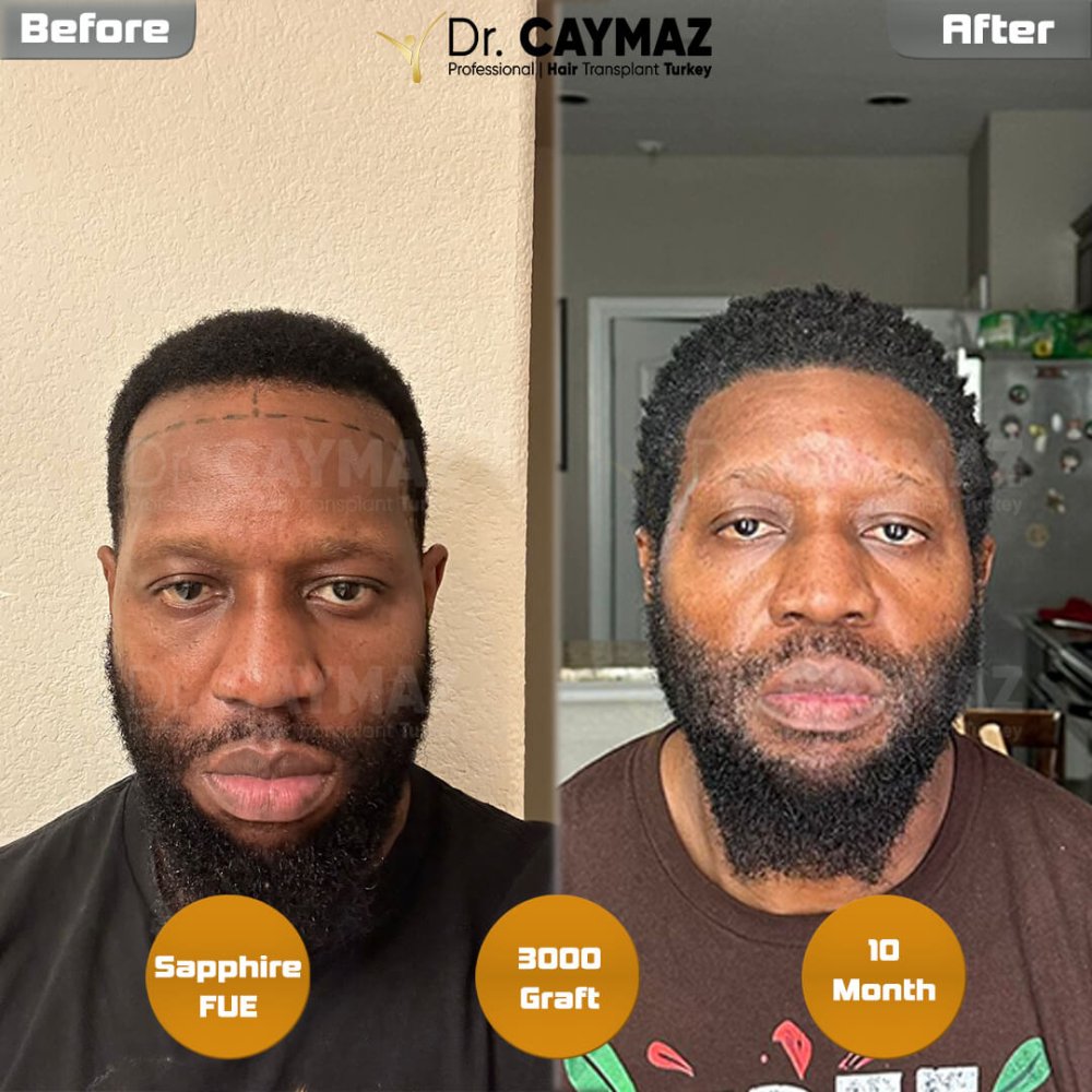 Hair transplant before & after result — frontal, schläfen, bart, 3,000 grafts, Sapphire FUE, 10 months post-op, Norwood 3 — Dr. Erkam Caymaz, Istanbul
