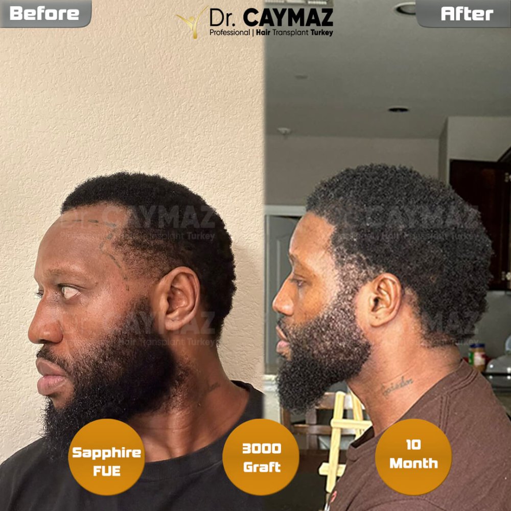 Hair transplant before & after result — frontal, schläfen, bart, 3,000 grafts, Sapphire FUE, 10 months post-op, Norwood 3 — Dr. Erkam Caymaz, Istanbul