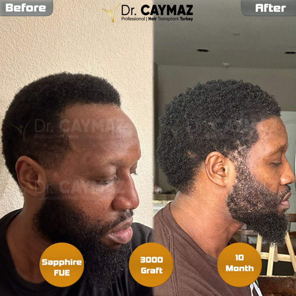 Hair transplant before & after result — frontal, schläfen, bart, 3,000 grafts, Sapphire FUE, 10 months post-op, Norwood 3 — Dr. Erkam Caymaz, Istanbul