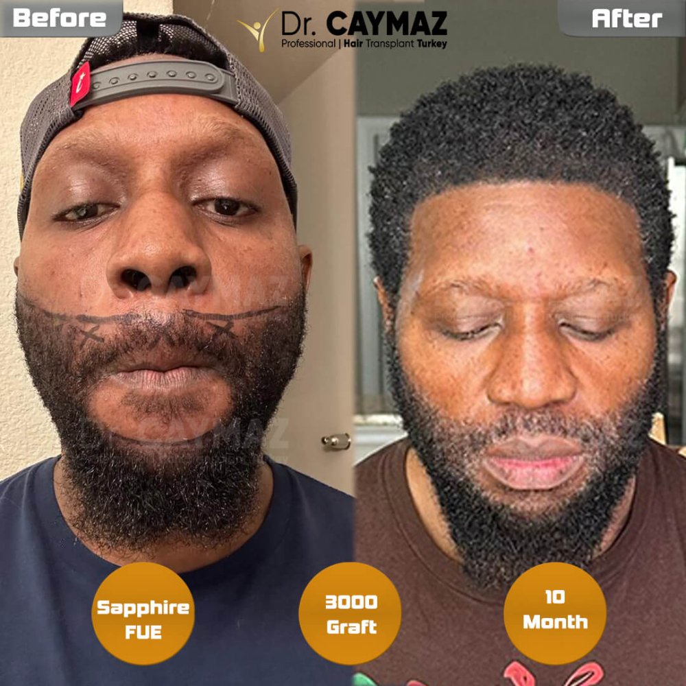 Hair transplant before & after result — frontal, schläfen, bart, 3,000 grafts, Sapphire FUE, 10 months post-op, Norwood 3 — Dr. Erkam Caymaz, Istanbul