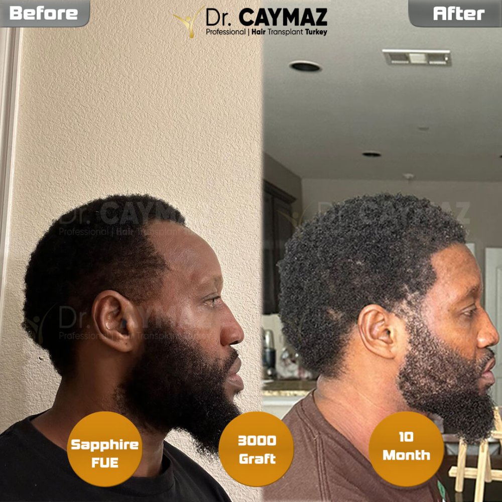 Hair transplant before & after result — frontal, schläfen, bart, 3,000 grafts, Sapphire FUE, 10 months post-op, Norwood 3 — Dr. Erkam Caymaz, Istanbul