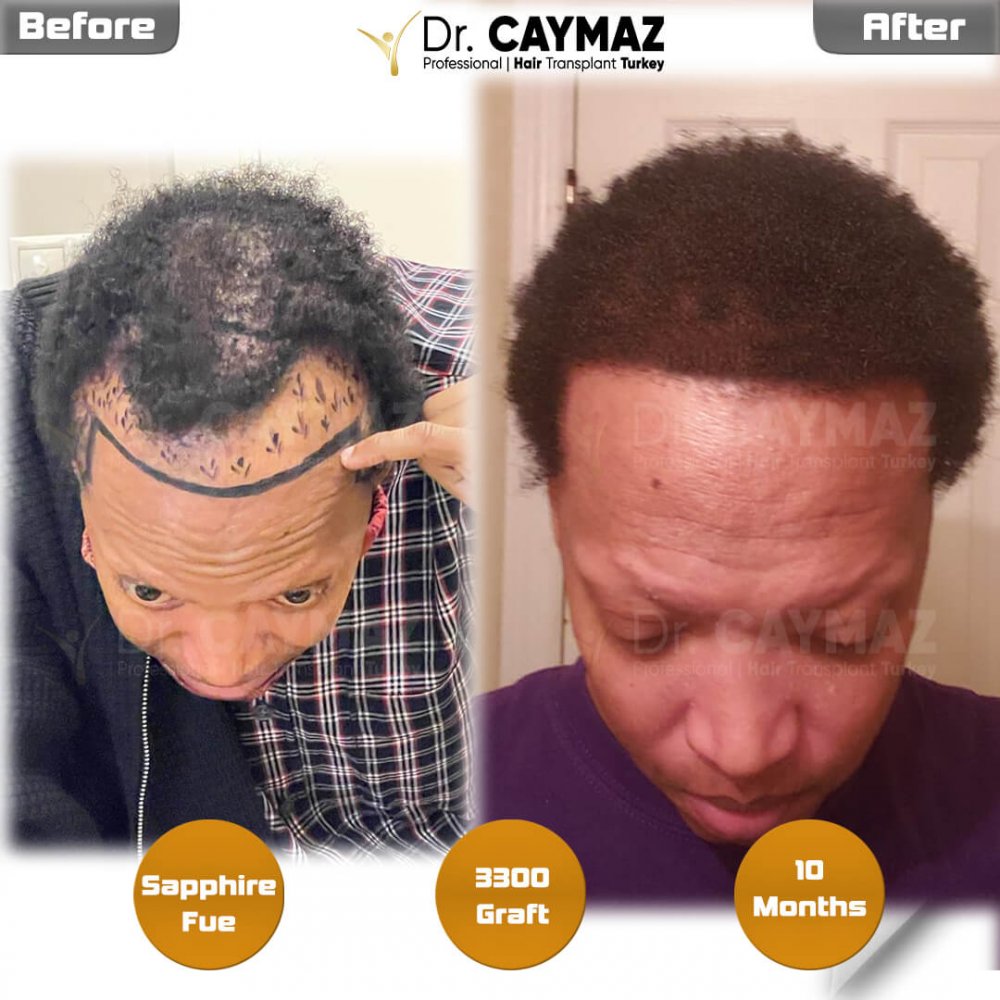 Mr.Becton - 10-months -3300 graft - Afro-American Sapphire Incision — hair transplant before & after — frontal, temples, 3,300 grafts, Sapphire FUE, 10 months post-op, Norwood 3 — Dr. Erkam Caymaz, Istanbul