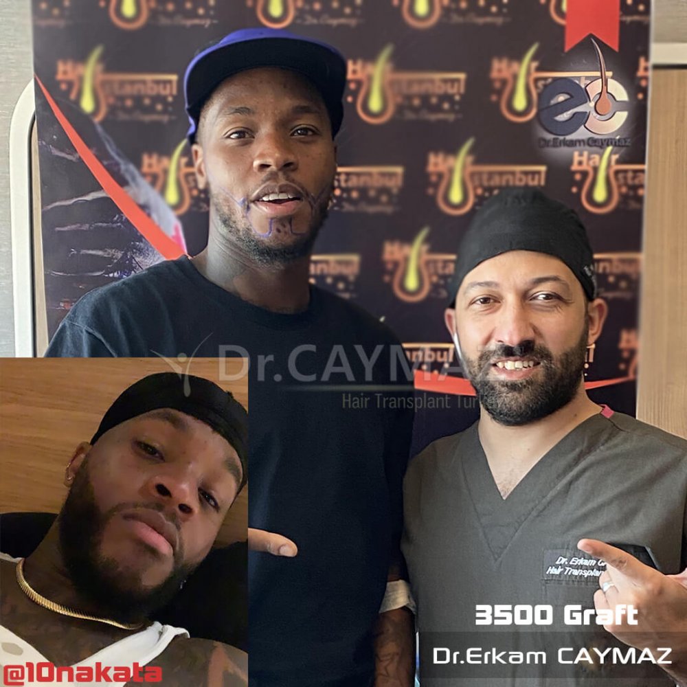 Mr Bossekota 3500 graft Afroamerican Beard Transplantation — hair transplant before & after — barba, 3,500 grafts, Sapphire FUE — Dr. Erkam Caymaz, Istanbul
