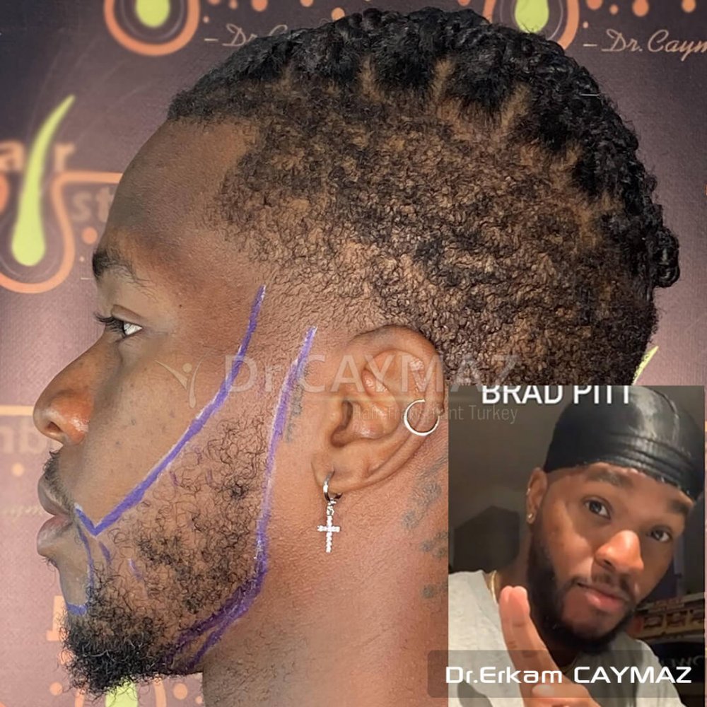 Mr Bossekota 3500 graft Afroamerican Beard Transplantation — hair transplant before & after — barba, 3,500 grafts, Sapphire FUE — Dr. Erkam Caymaz, Istanbul