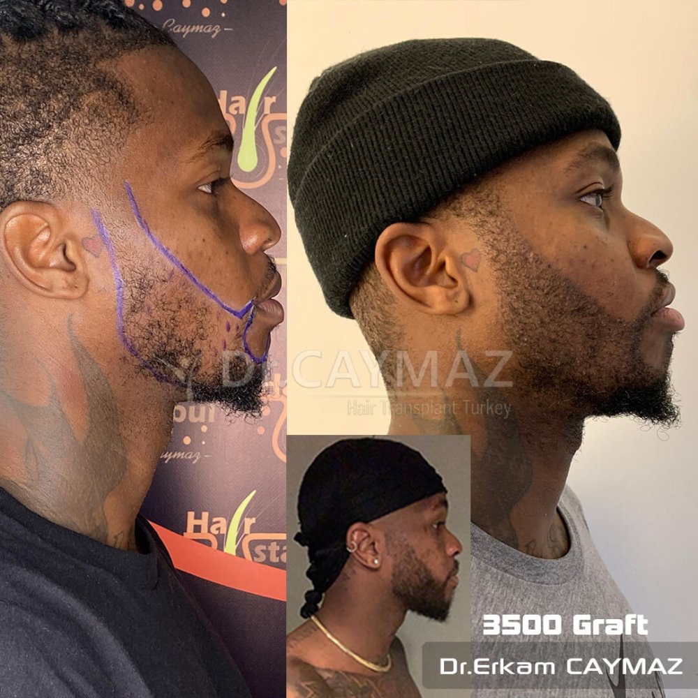 Mr Bossekota 3500 graft Afroamerican Beard Transplantation — hair transplant before & after — barba, 3,500 grafts, Sapphire FUE — Dr. Erkam Caymaz, Istanbul