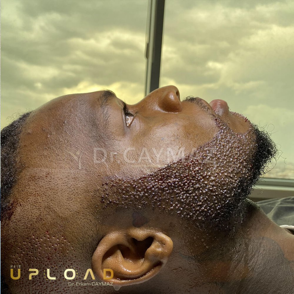 Mr Bossekota 3500 graft Afroamerican Beard Transplantation — hair transplant before & after — barba, 3,500 grafts, Sapphire FUE — Dr. Erkam Caymaz, Istanbul