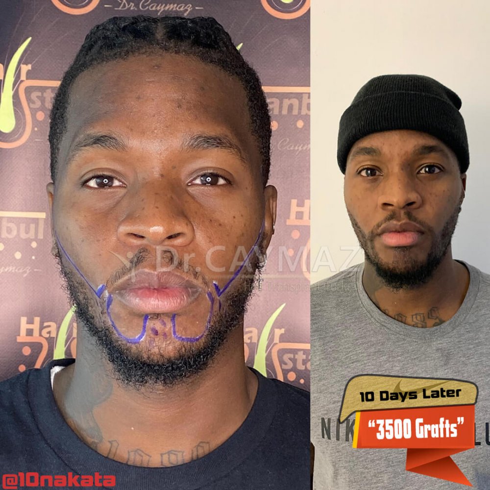 Mr Bossekota 3500 graft Afroamerican Beard Transplantation — hair transplant before & after — barba, 3,500 grafts, Sapphire FUE — Dr. Erkam Caymaz, Istanbul