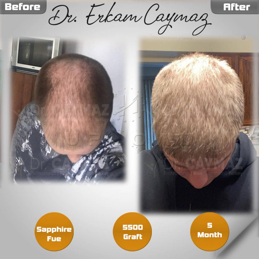 Hair transplant before & after result — frontal, kopfoberseite, kronenregion, 5,500 grafts, Sapphire FUE, 5 months post-op, Norwood 5 — Dr. Erkam Caymaz, Istanbul