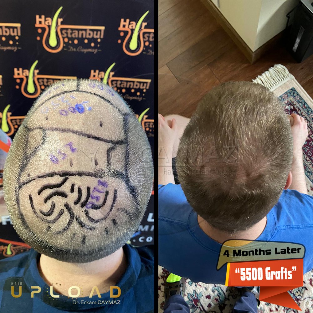 Hair transplant before & after result — frontal, kopfoberseite, kronenregion, 5,500 grafts, Sapphire FUE, 5 months post-op, Norwood 5 — Dr. Erkam Caymaz, Istanbul